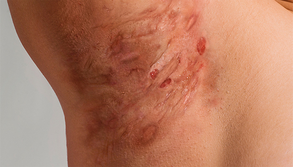 HIDRADENITIS SUPPURATIVA contraindications In beauty therapy