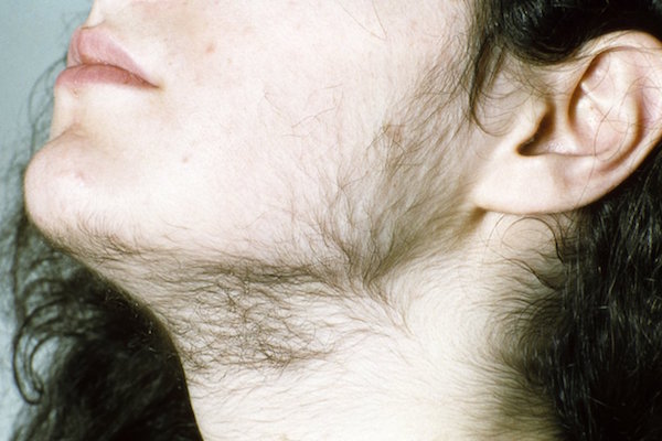 HIRSUTISM contraindications In beauty therapy