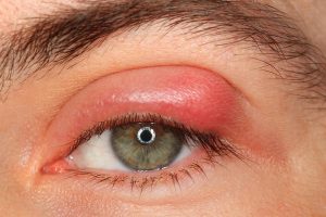 HORDEOLUM (STYE) contraindications In beauty therapy