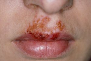 IMPETIGO contraindications In beauty therapy