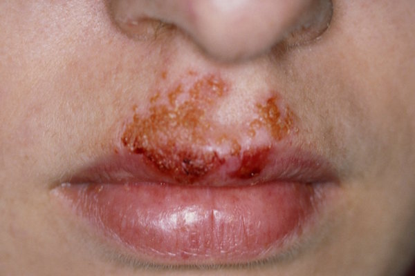 IMPETIGO contraindications In beauty therapy
