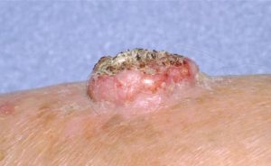 KERATOACANTHOMA contraindications In beauty therapy