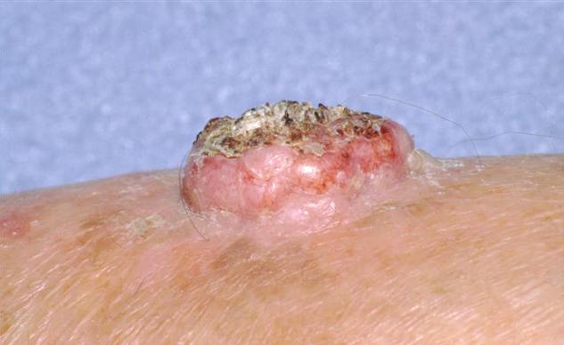 KERATOACANTHOMA contraindications In beauty therapy