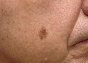 LENTIGO MALIGNA contraindications In beauty therapy