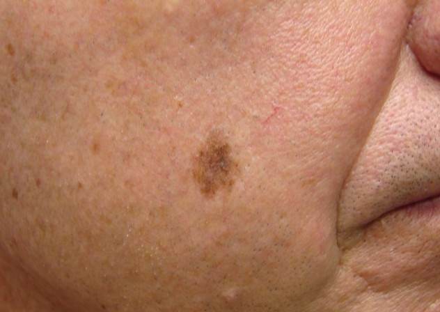 LENTIGO MALIGNA contraindications In beauty therapy