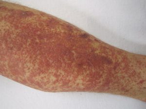 LEUKOCYTOCLASTIC VASCULITIS (HYPERSENSITIVITY VASCULITIS) contraindications In beauty therapy