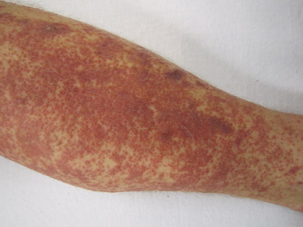 LEUKOCYTOCLASTIC VASCULITIS (HYPERSENSITIVITY VASCULITIS) contraindications In beauty therapy