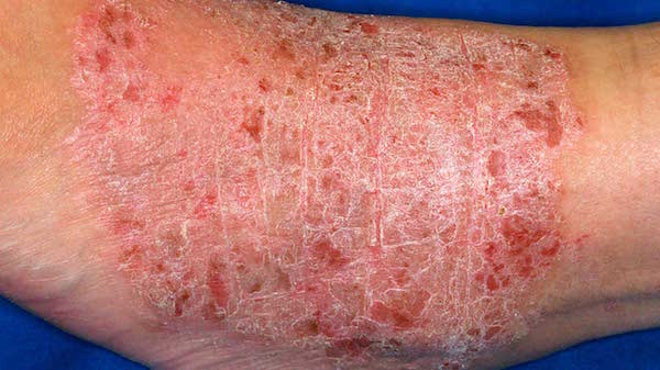 LICHEN SIMPLEX CHRONICUS contraindications In beauty therapy