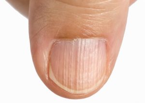 LONGITUDINAL GROOVES contraindications In beauty therapy