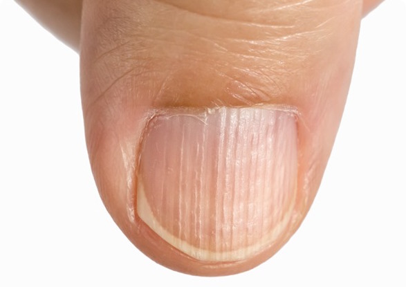 LONGITUDINAL GROOVES contraindications In beauty therapy