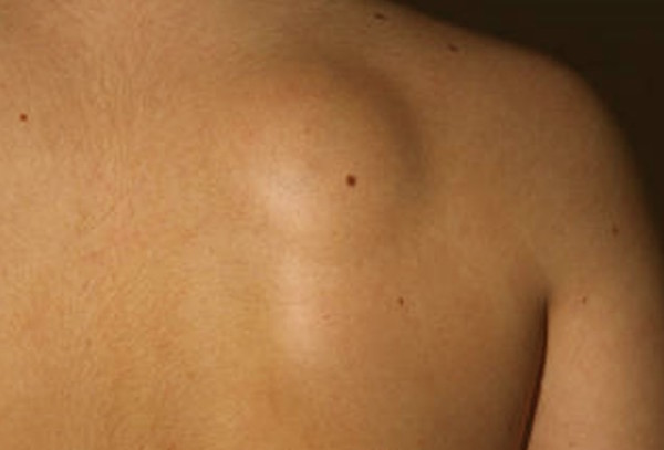 LUMP AND SWELLING (Undiagnosed) (SWELLING (Undiagnosed)) contraindications In beauty therapy