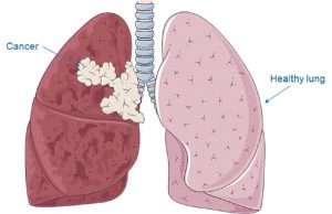 LUNG CANCER contraindications In beauty therapy
