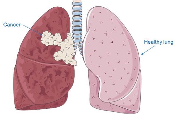 LUNG CANCER contraindications In beauty therapy