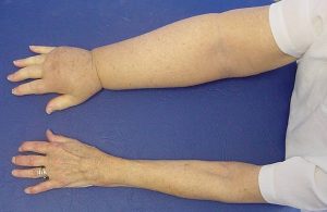 LYMPHOEDEMA contraindications In beauty therapy