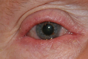 MADAROSIS contraindications In beauty therapy
