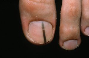 MELANONYCHIA contraindications In beauty therapy
