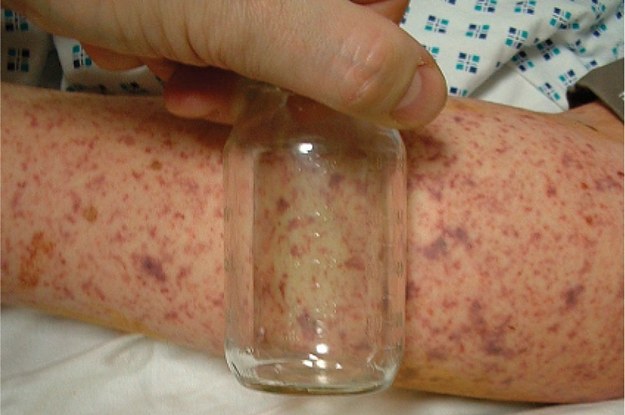 MENINGITIS contraindications In beauty therapy
