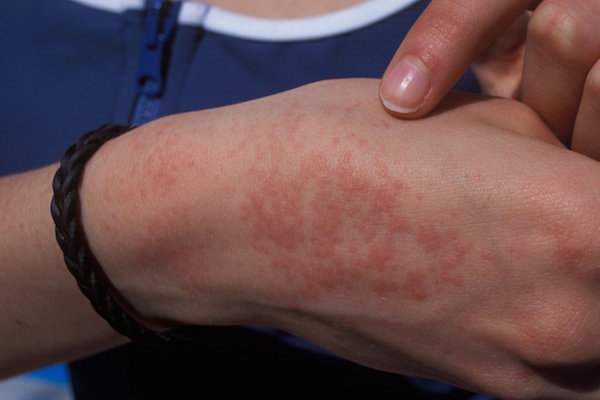 MILIARIA contraindications In beauty therapy