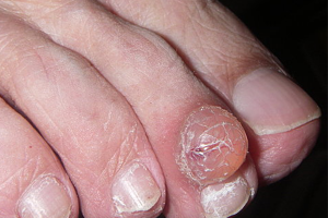 MUCOUS CYST contraindications In beauty therapy
