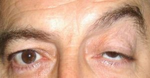 MYASTHENIA GRAVIS contraindications In beauty therapy