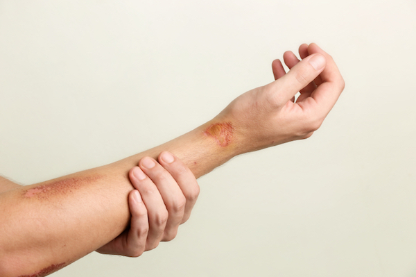 INJURIES contraindications In beauty therapy