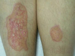 NECROBIOSIS LIPOIDICA contraindications In beauty therapy