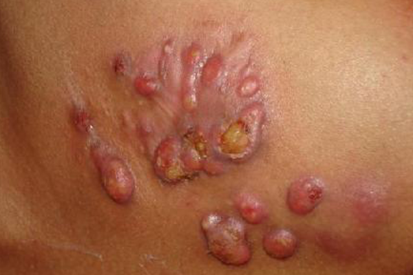 NOCARDIOSIS contraindications In beauty therapy