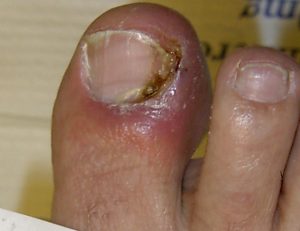 ONYCHIA contraindications In beauty therapy