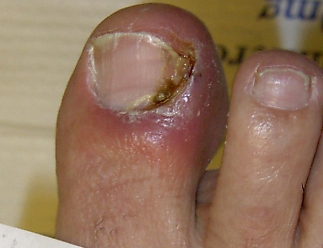 ONYCHIA contraindications In beauty therapy