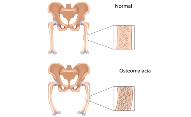 OSTEOMALACIA contraindications In beauty therapy
