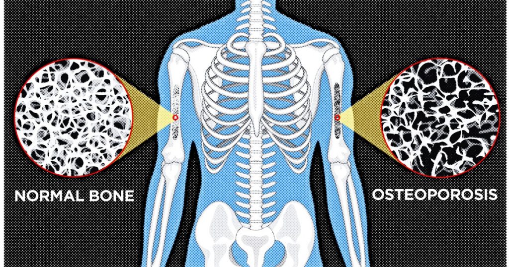 OSTEOPOROSIS contraindications In beauty therapy