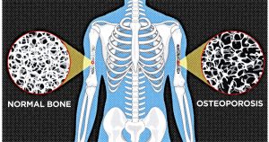 OSTEOPOROSIS contraindications In beauty therapy