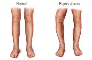 PAGET’S DISEASE contraindications In beauty therapy