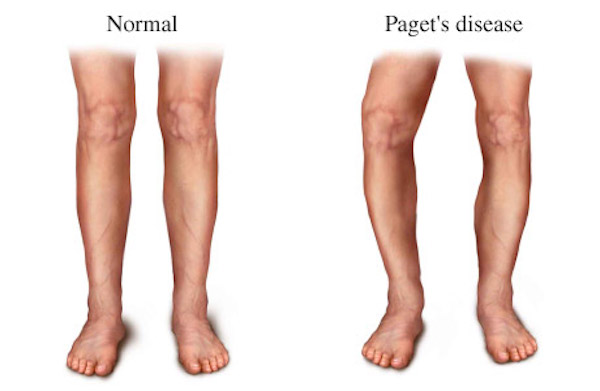 PAGET’S DISEASE contraindications In beauty therapy