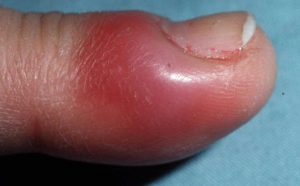 PARONYCHIA contraindications In beauty therapy