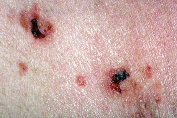 PEMPHIGUS VULGARIS contraindications In beauty therapy