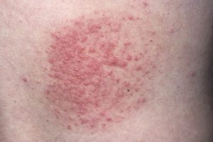 POLYMORPHIC LIGHT ERUPTION contraindications In beauty therapy