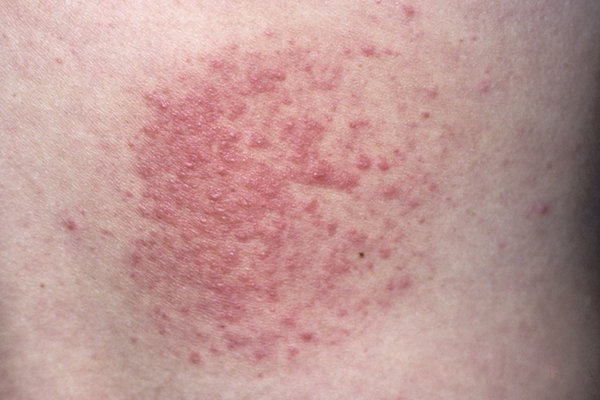 POLYMORPHIC LIGHT ERUPTION contraindications In beauty therapy