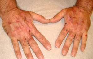 PORPHYRIA CUTANEA TARDA (PCT) contraindications In beauty therapy