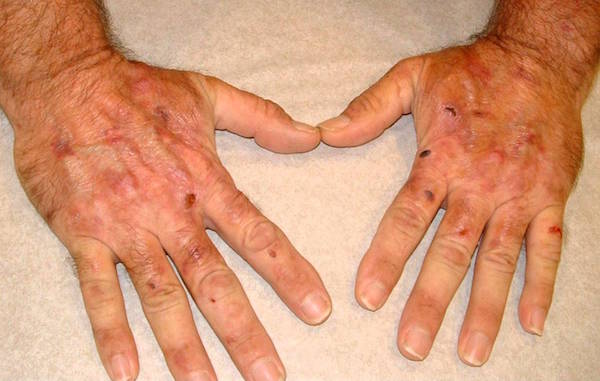 PORPHYRIA CUTANEA TARDA (PCT) contraindications In beauty therapy