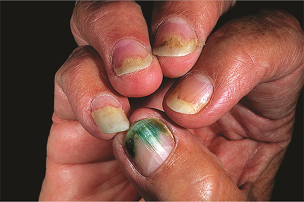 PSEUDOMONAS BACTERIA GREENIES contraindications In beauty therapy