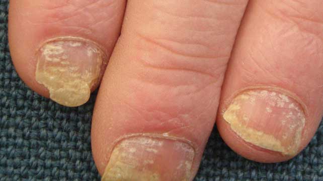 PSORIASIS OF THE NAILS contraindications In beauty therapy