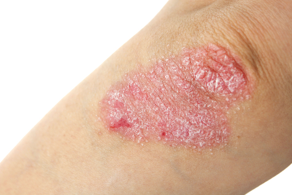 PSORIASIS contraindications In beauty therapy