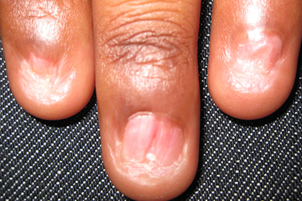 PTERYGIUM contraindications In beauty therapy