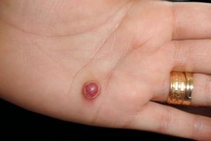 PYOGENIC GRANULOMA contraindications In beauty therapy