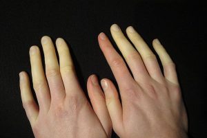 RAYNAUD’S PHENOMENON contraindications In beauty therapy