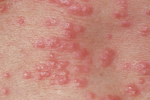 SCABIES contraindications In beauty therapy