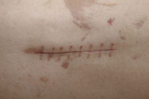 SCAR contraindications In beauty therapy