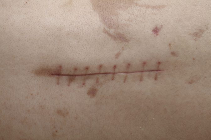 SCAR contraindications In beauty therapy