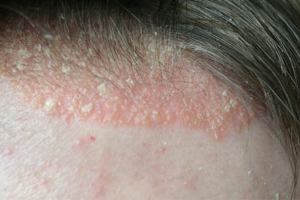 SEBORRHEIC DERMATITIS contraindications In beauty therapy